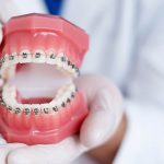 Ortodonti Tedavisi Nedir? Diş Teli Çeşitleri Nelerdir?