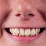 Çarpık Diş Nedenleri Nelerdir? Tedavisi Nasıldır?