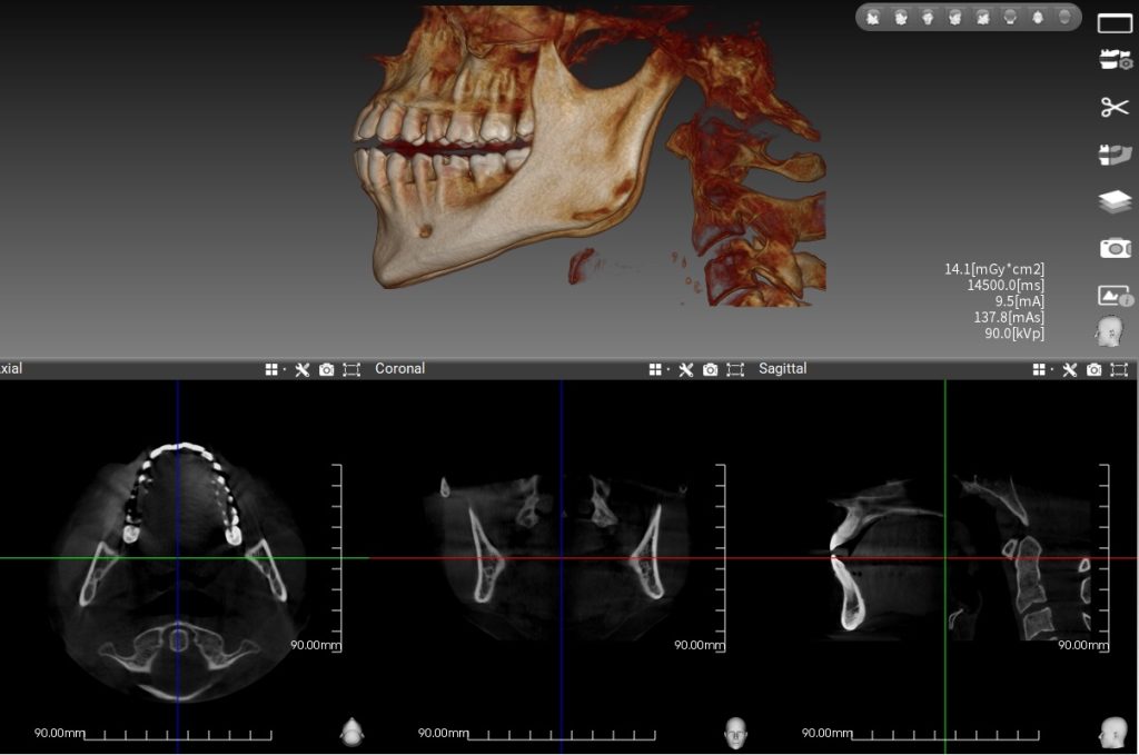Dental tomografide radyasyon var mıdır