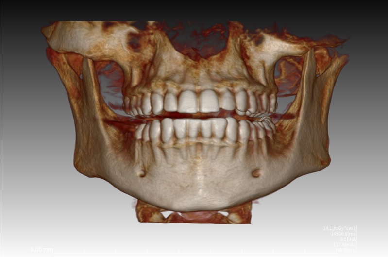Dental tomografinin avantajları
